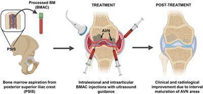 Frontiers | Intralesional Injection of Bone Marrow Aspirate Concentrate